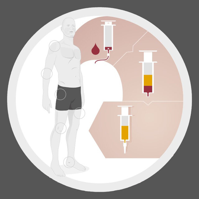 Grafische Darstellung der ACP Therapie